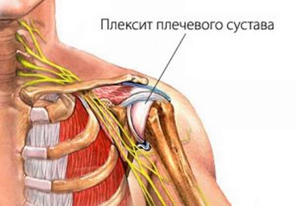 Защемление нерва в плече